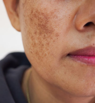 Pigmentation