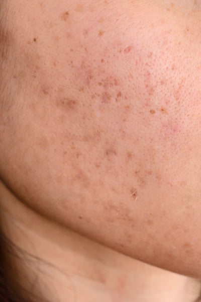 Dark Spots